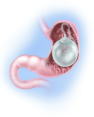 The Pros and Cons of Gastric Balloon Placement for Long-Term Weight Loss