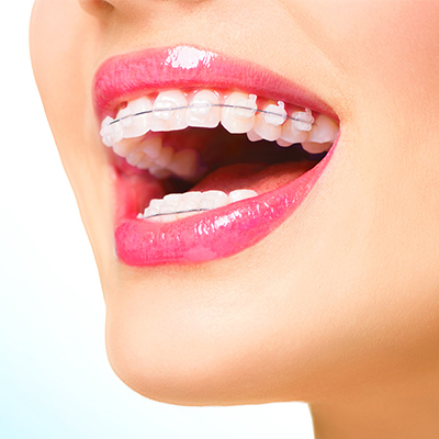 How to Know When You Need Braces in Dubai: A Dental Guide