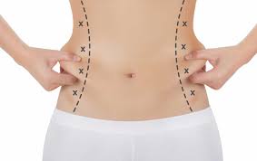 Top 5 Tips to Keep Your Liposuction Results for Good