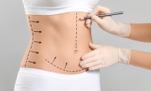 What Are the Different Types of Liposuction Available in Dubai?