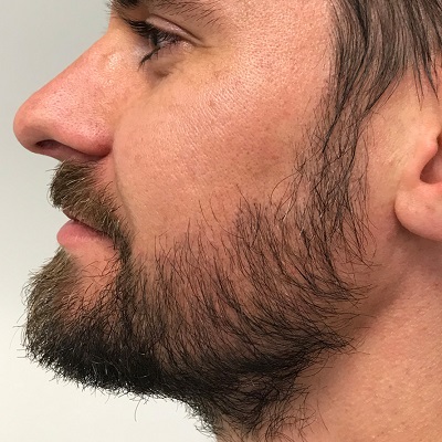The Key Factors for Achieving the Perfect Beard with a Hair Transplant