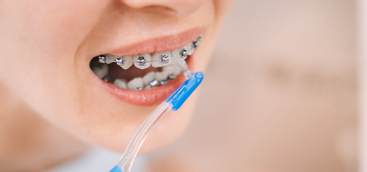 Braces Care: Maintaining Oral Hygiene During Treatment
