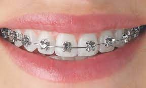 Top Picks for Affordable Braces Providers in Dubai
