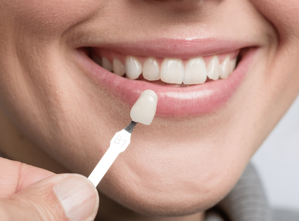 Transform Your Teeth: Best Dental Veneers in Dubai