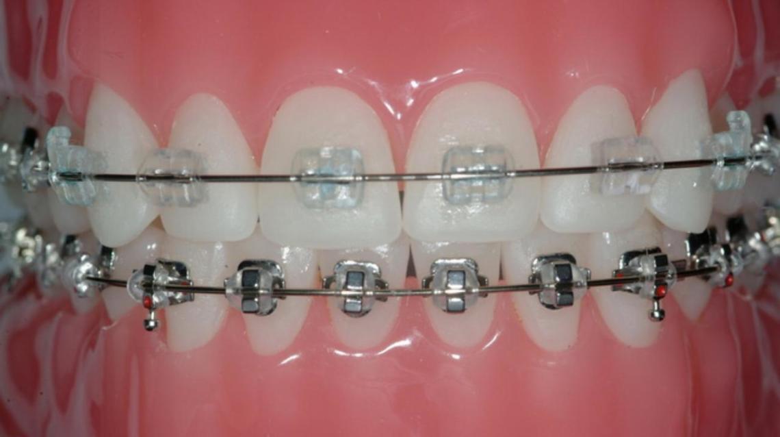 Transparent Dental Braces: A Modern Solution in Dubai