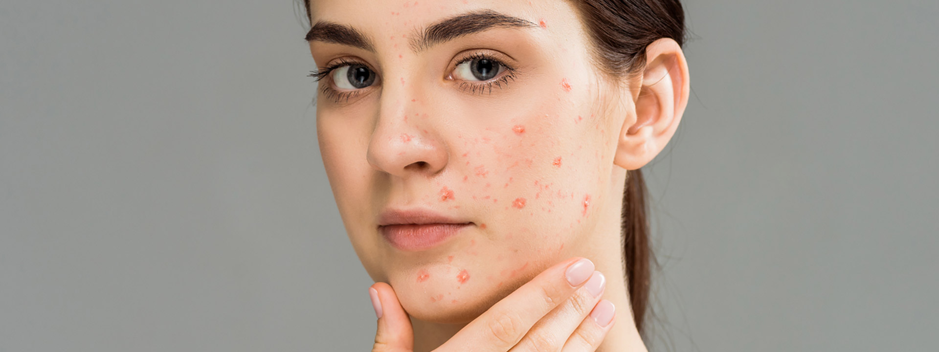 Brad Pitt's Acne Scar Journey: How Dubai’s Top Clinics Can Help You Too