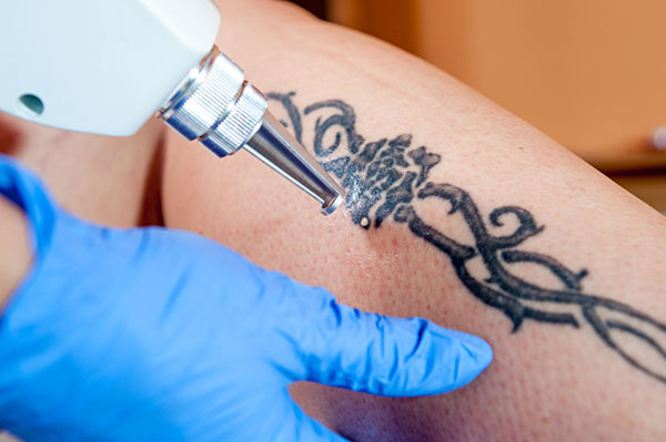 The Pros and Cons of Picosure Tattoo Removal in Dubai