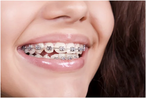 Dental Braces in Dubai: Achieving Your Dream Smile Starts Here