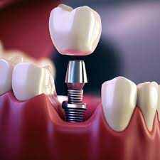 The Steps Involved in Getting a Single Tooth Implant in Dubai