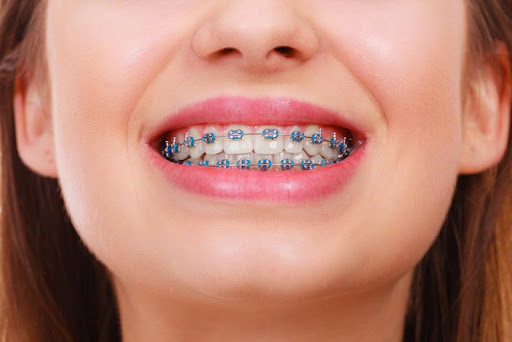 Dental Braces in Dubai: Discover the Unexpected Benefits Beyond Just a Beautiful Smile