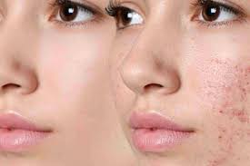 What’s the Ideal Time Frame for Acne Treatments to Show Improvement?
