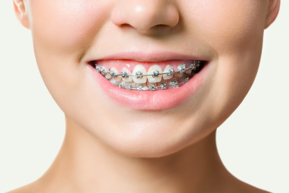 Braces in Dubai: Key Pricing Insights and Financing Choices