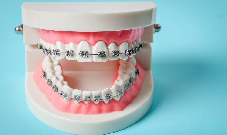 Braces and Their Role in Enhancing Your Smile's Alignment in Dubai