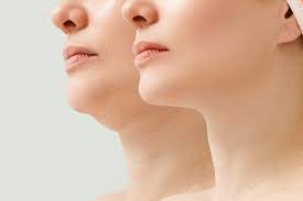 What's the Best Non-Surgical Treatment for Double Chin?