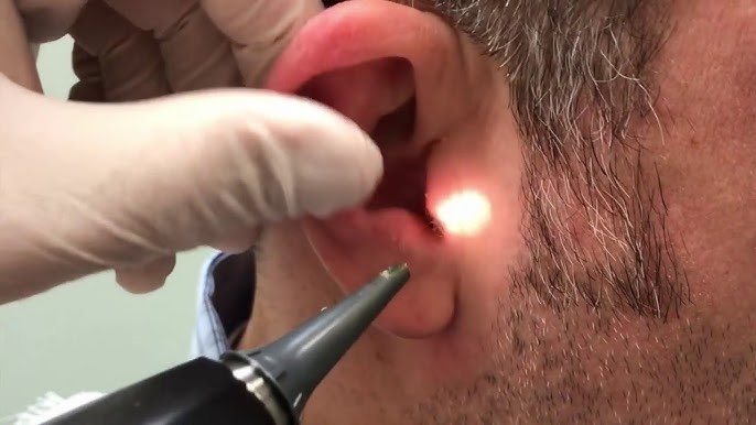 Ear Wax Removal: A Look at Its Impact on Different Individuals