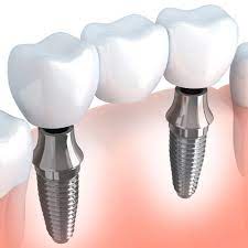 Single Tooth Implant: A Lifelong Investment in Your Smile