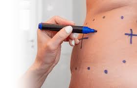 Non-Surgical Liposuction Alternatives: Effectiveness and Insights
