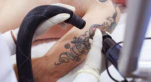 Discover Picosure: A Safe Way to Remove Tattoos Without Scarring