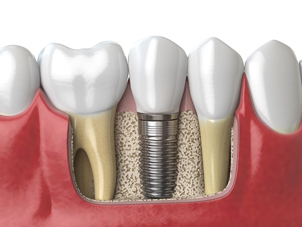 Recovering from Dental Implant Surgery: Tips for a Smooth Healing Process
