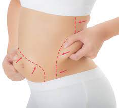 The Most Popular Liposuction Techniques & Their Benefits