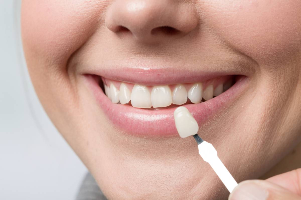 The Instant Smile Makeover: Exploring Dental Veneers Options