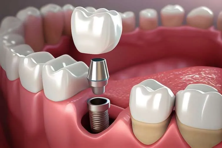 Can a Single Tooth Implant Prevent Bone Loss in the Jaw?