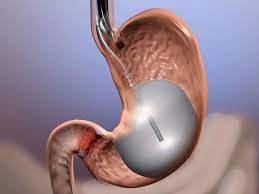 Gastric Balloon vs. Ozempic: Which Is the Better Weight Loss Solution?
