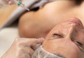 Understanding Mesotherapy: A Guide to Skin Benefits and Applications