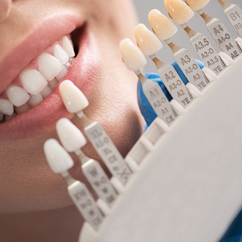 The Lasting Impact of Dental Veneers on Your Smile Journey
