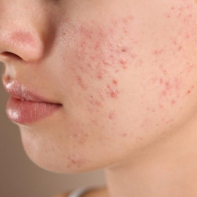 The Top Dermatologist-Recommended Treatments for Acne Spot Scars