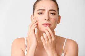 Acne Treatment Insights: Solutions for a Healthier Complexion