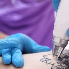 Demystifying the Session Process of Pico Laser Tattoo Removal