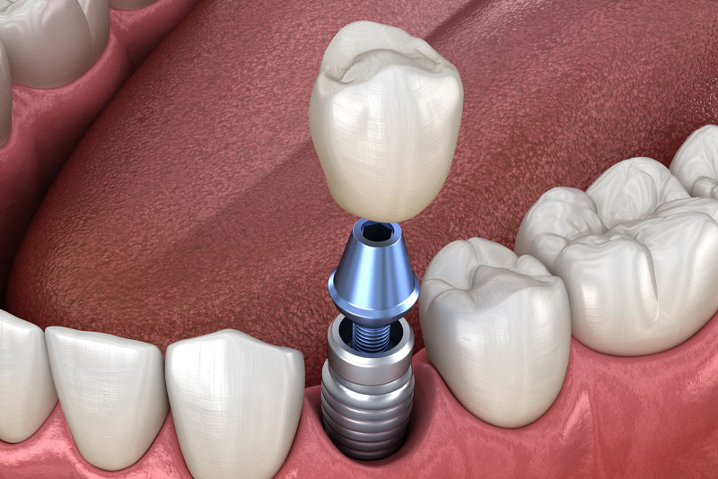 Long-Term Benefits of Dental Implants You Should Know