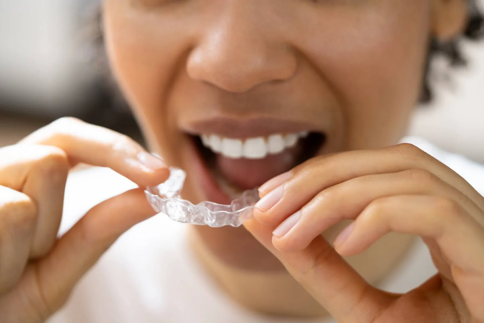 Enhance Your Invisalign Experience: Speed Up Tooth Movement