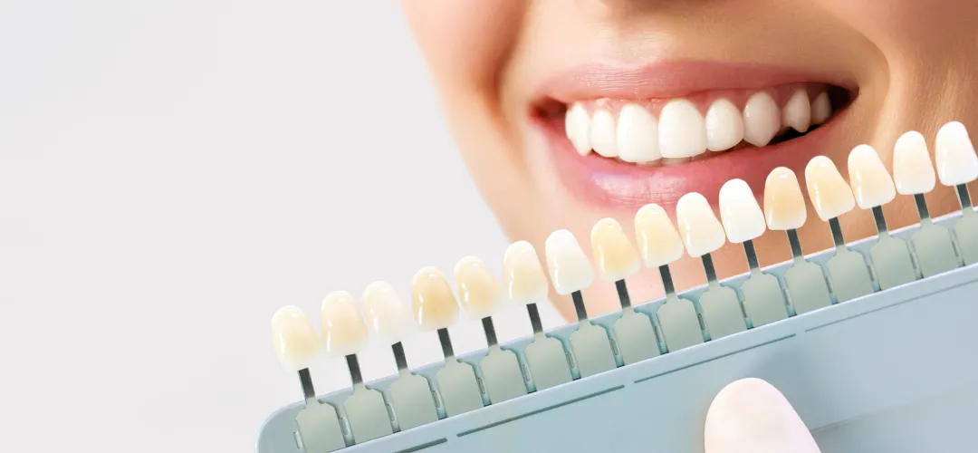 Enhancing Your Smile: The Value of Dental Veneers Explained