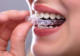 Invisalign Care Tips: How to Maintain Your Clear Braces for Optimal Results